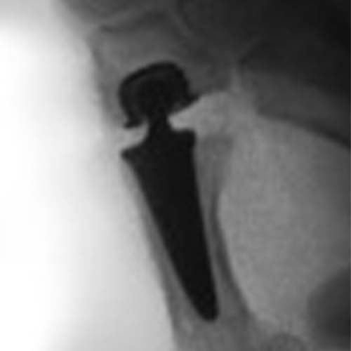 arthrose du pouce de la main operation rhizarthrose operation chirurgien orthopediste specialiste de la main chirurgie main paris cot-est tournan en brie clinique orthopedique paris grand est 77