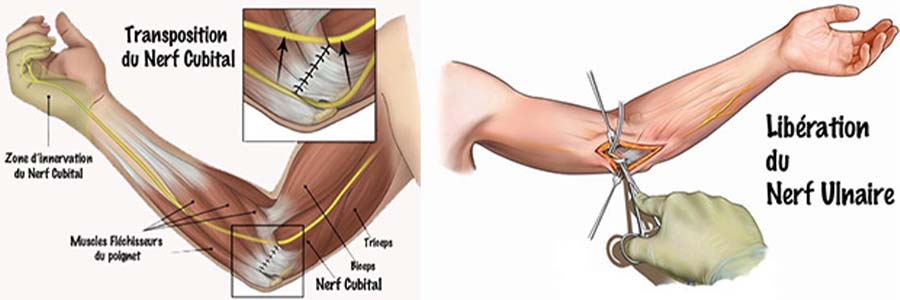 compression nerf cubital nerf ulnaire du coude trajet chirurgien orthopediste specialiste de la main chirurgie main paris cot-est tournan en brie clinique orthopedique paris grand est 77
