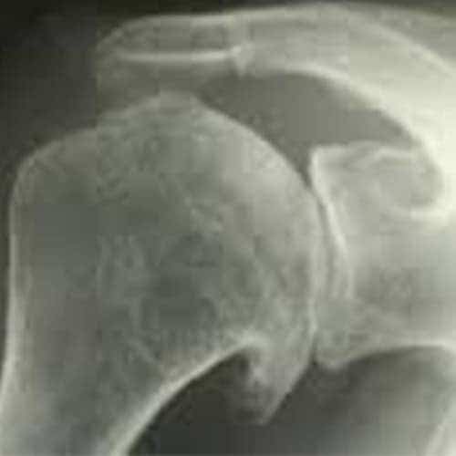 douleur arthrose epaule symptomes operation chirurgien orthopediste specialiste epaule cot-est tournan en brie clinique orthopedique paris grand est 77