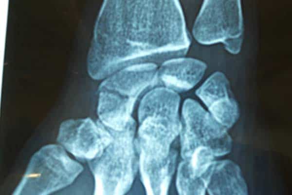 fracture os scaphoide main poignet chirurgien orthopediste specialiste de la main chirurgie main paris cot-est tournan en brie clinique orthopedique paris grand est 77