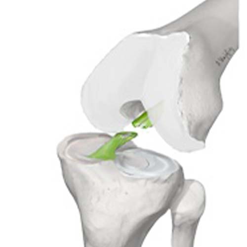 ligamentoplastie rupture de ligament croise anterieurchirurgien orthopediste du genou specialistes du genou cot-est tournan en brie clinique orthopedique paris grand est 77