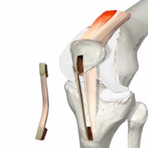 operation le ligament croise anterieur symptome lca genouchirurgien orthopediste du genou specialistes du genou cot-est tournan en brie clinique orthopedique paris grand est 77