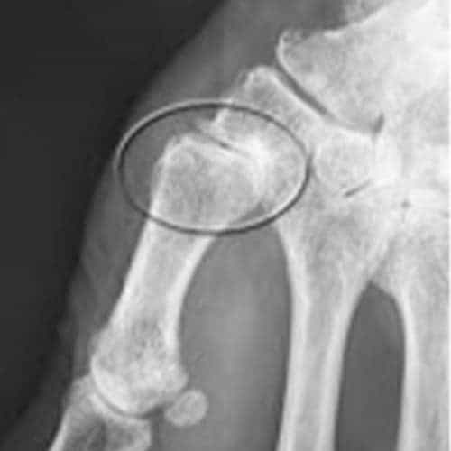rhizarthrose bilaterale traitement rhizarthrose quand operer chirurgien orthopediste specialiste de la main chirurgie main paris cot-est tournan en brie clinique orthopedique paris grand est 77