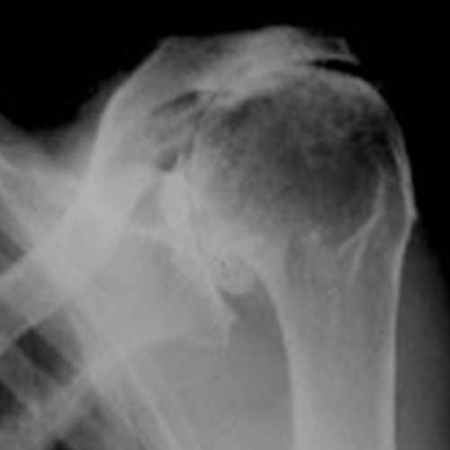 soulager arthrose epaule bras traitement chirurgien orthopediste specialiste epaule cot-est tournan en brie clinique orthopedique paris grand est 77