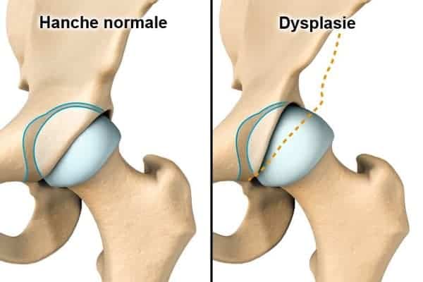 dysplasie luxation congenitale hanche traitement chirurgie chirurgien orthopediste specialiste hanche paris cot-est tournan en brie clinique