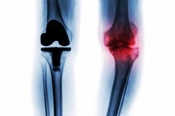 prothese genou totale unicompartimentale comment choisir avantages indications chirurgien orthopediste specialiste genou paris cot-est tournan en brie clinique