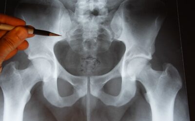 Qu’est-ce qu’une dysplasie de la hanche ?
