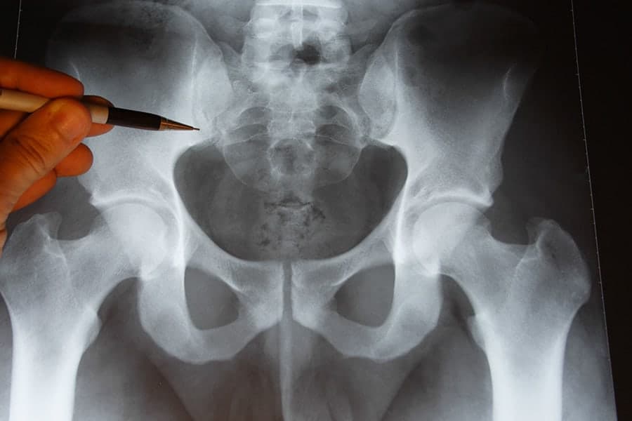 c est quoi une dysplasie de la hanche chirurgien orthopediste specialiste hanche paris cot est tournan en brie clinique