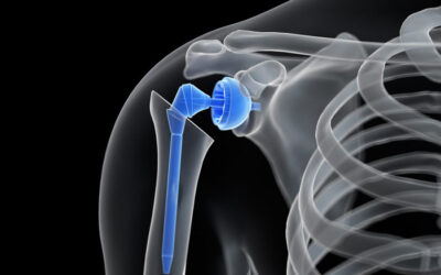 Prothèse d’épaule inversée : quels mouvements sont interdits ?