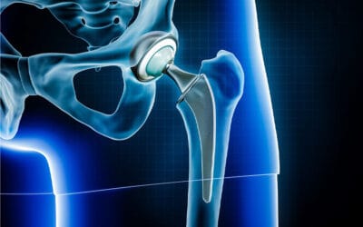 Descellement de prothèse de hanche : quel examen d’imagerie ?