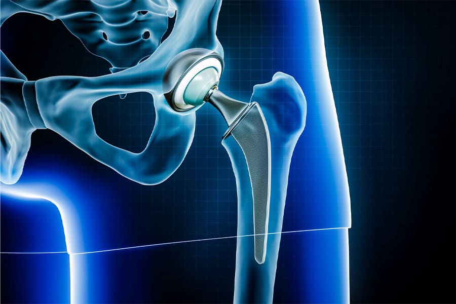 descellement prothese de hanche imagerie clinique orthopedique cot est dr stephane fournol chirurgien orthopediste specialiste chirurgie prothetique de la hanche paris grand est.jpg