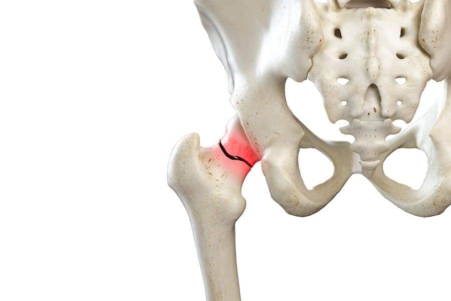 Col du fémur cassé : que faire en cas de fracture ?