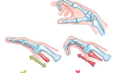 Doigt à ressaut : traitement médical ou chirurgie ?