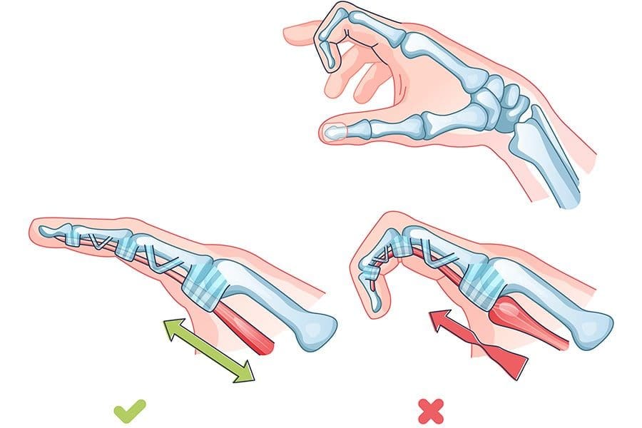 doigt a ressaut traitement medical ou chirurgie cotest