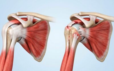 Douleur de l’épaule : comment reconnaitre une rupture de la coiffe ?