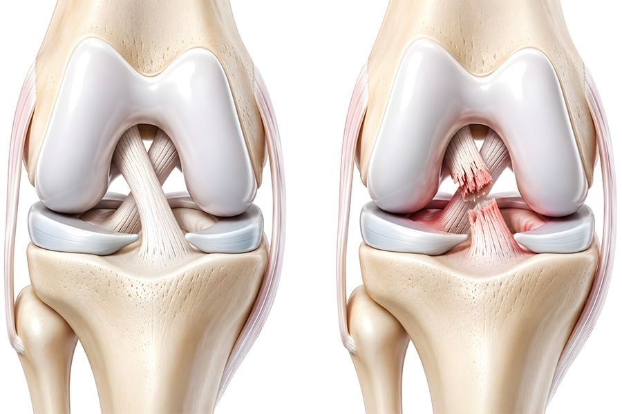 Rupture du ligament croisé : faut-il toujours se faire opérer ?